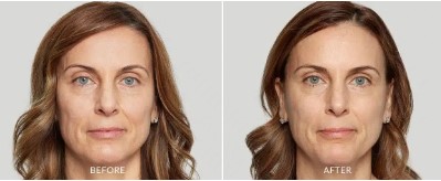 What Sculptra Injection Right For You