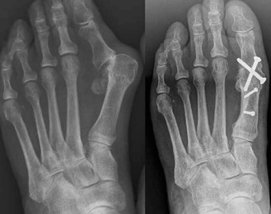 Why Consider Mtp Arthrodesis For Foot Pain Relief