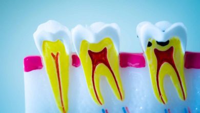 Root Canal: A Lifesaver for Your Tooth