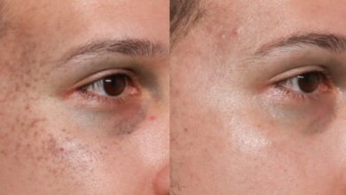 What Are the Benefits of Nevus of Ota Treatment